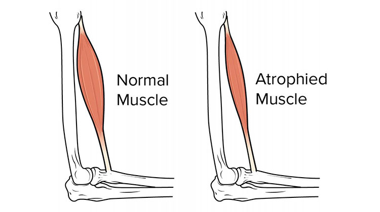 muscular-atrophy-featured-img