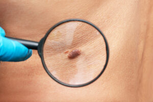 moles-on-your-skin-featured-img