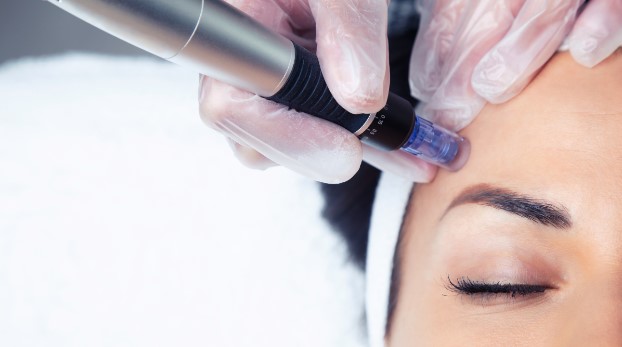 microneedling jan25 request img